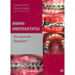 Мини-имплантаты. Ортодонтия будущего