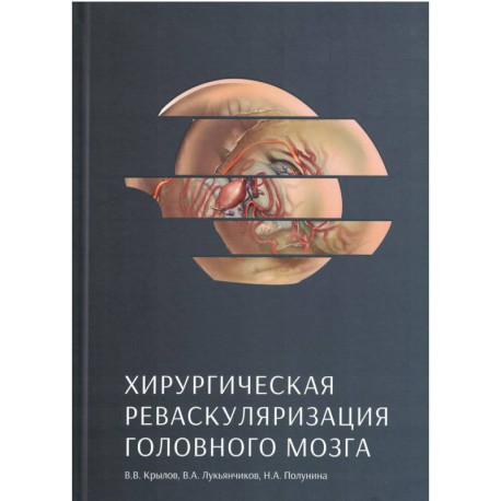 Хирургическая реваскуляризация головного мозга