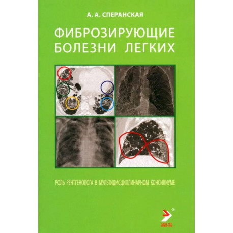 Фиброзирующие болезни легких. Роль рентгенолога в мультидисциплинарном консилиуме
