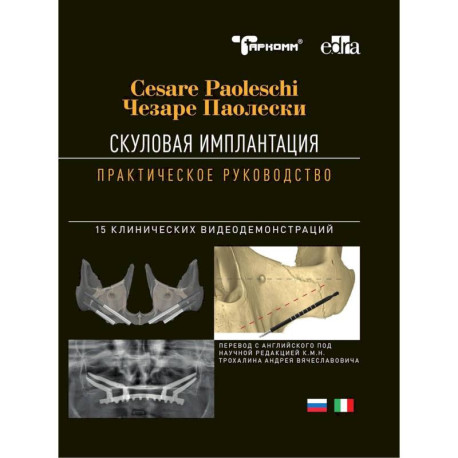 Скуловая имплантация. Практическое руководство - Чезаре Паолески