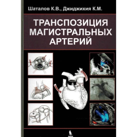 Транспозиция магистральных артерий